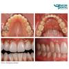 Kép 3/3 - Intraoral Photo Tükör 01, Occlusal