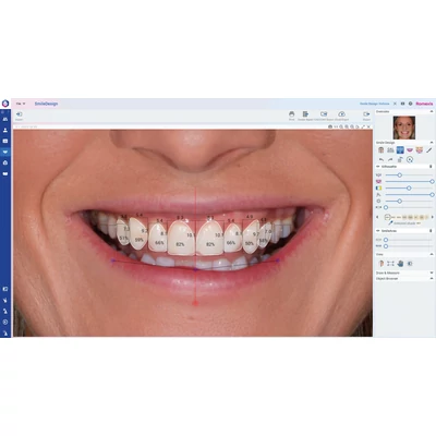 Romexis Smile Design Modul