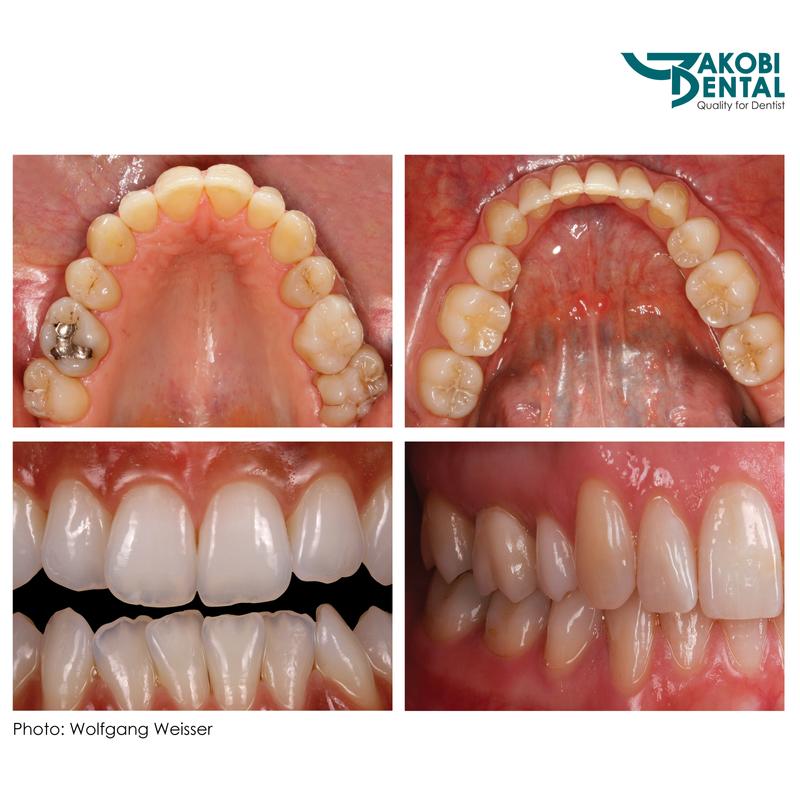 Intraoral Photo Tükör05, occlusal