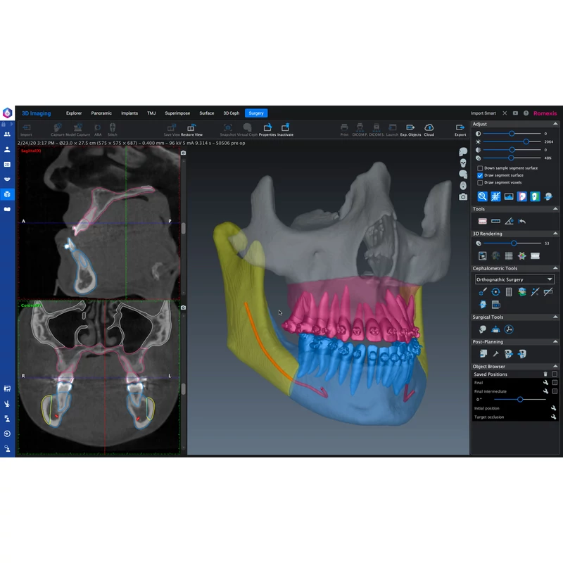 Romexis CMF Surgery