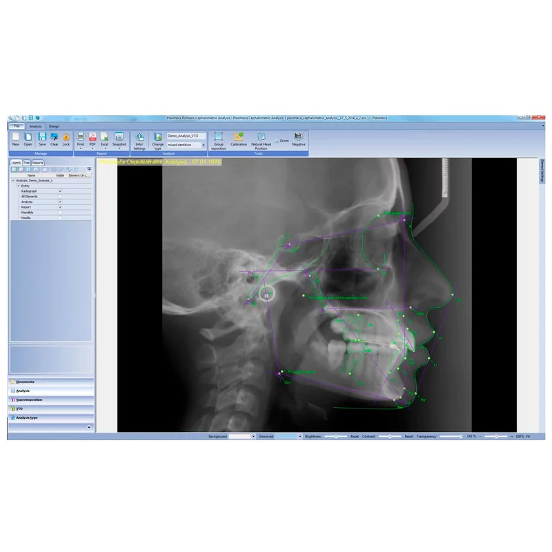 Romexis Cephalometric Ananlysis